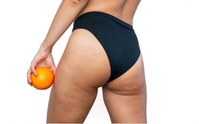 Fitness and Cellulite: Some Tips